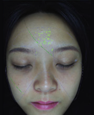 Wrinkle & fine line mapping