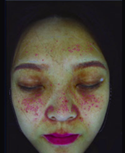 Superficial inflammation imaging